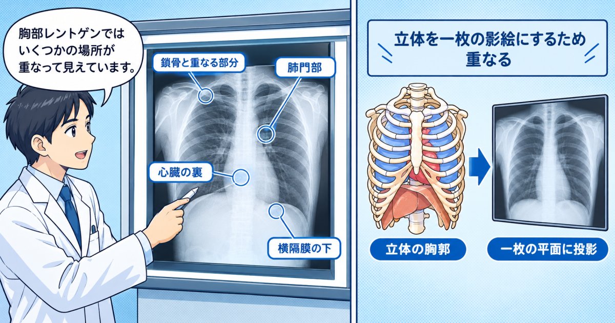 毎年の健康診断で肺がんが見落とされる医学的な背景